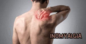 Inomyalgia Treatment & Management – Full Analysis